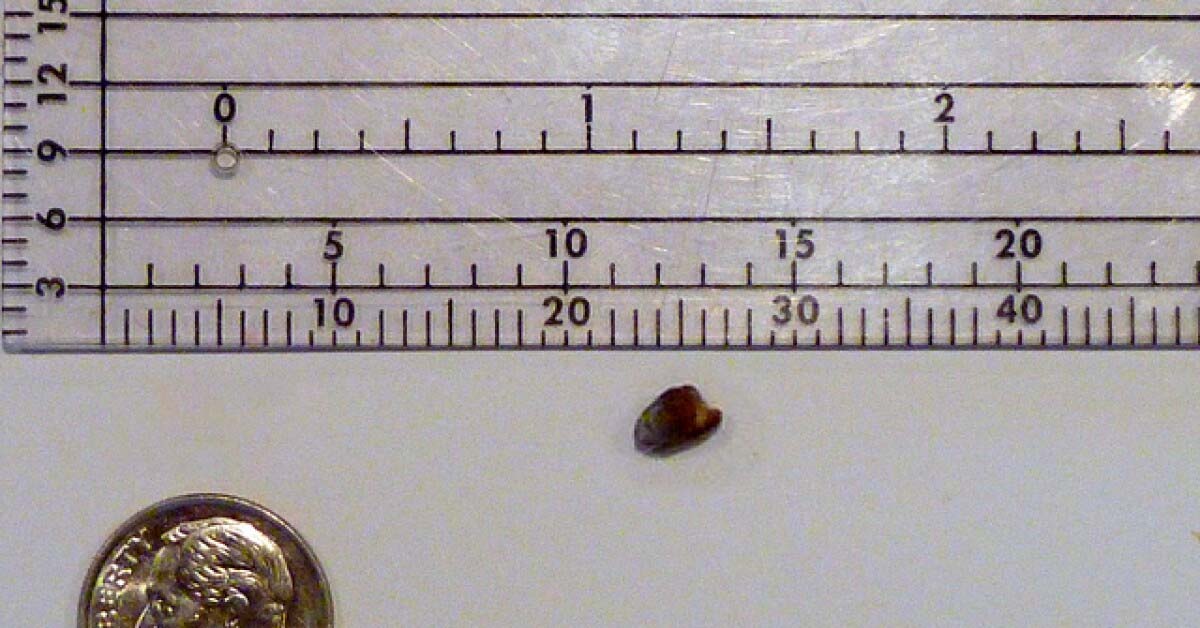 Sỏi thận trái 4mm thường chưa có biểu hiện bệnh Sỏi thận trái 4mm thường chưa có biểu hiện bệnh