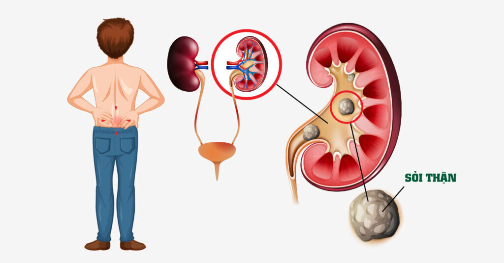 Sỏi Tái Phát Sau Mổ Là Do Đâu?