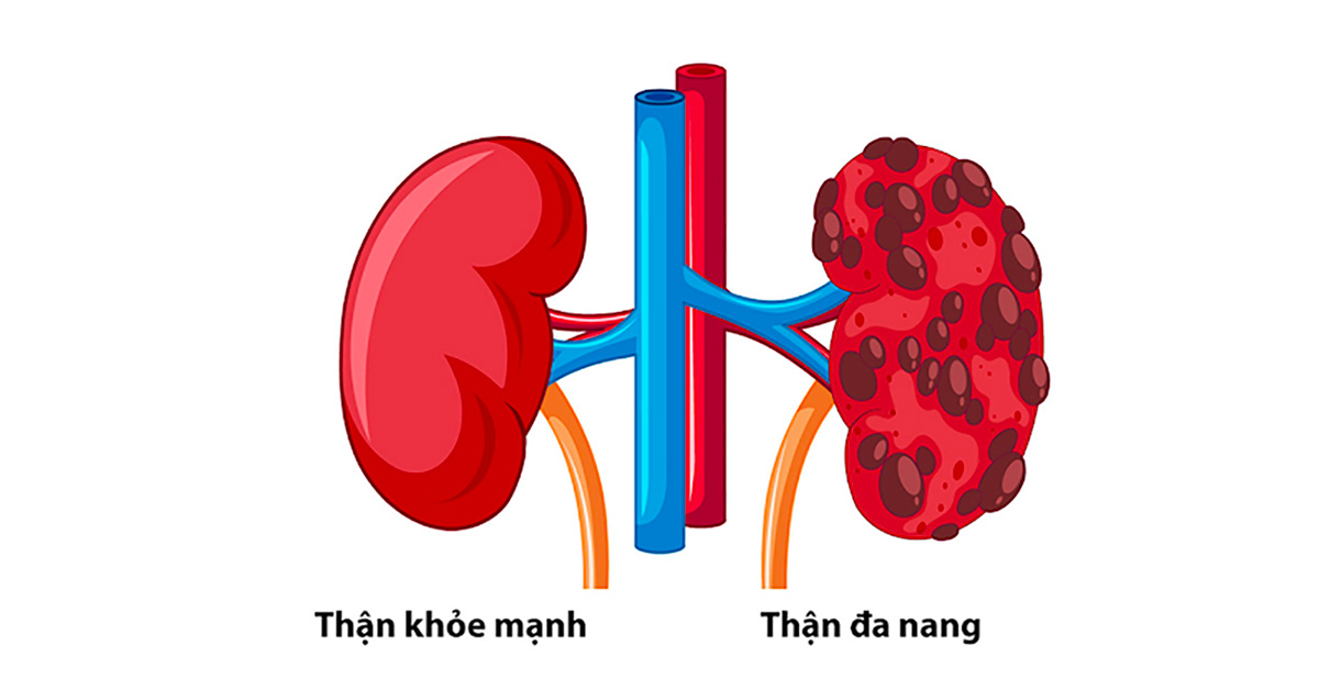 Thận đa nang là sự tập trung nhiều u nang phát triển bên trong thận Thận đa nang là sự tập trung nhiều u nang phát triển bên trong thận