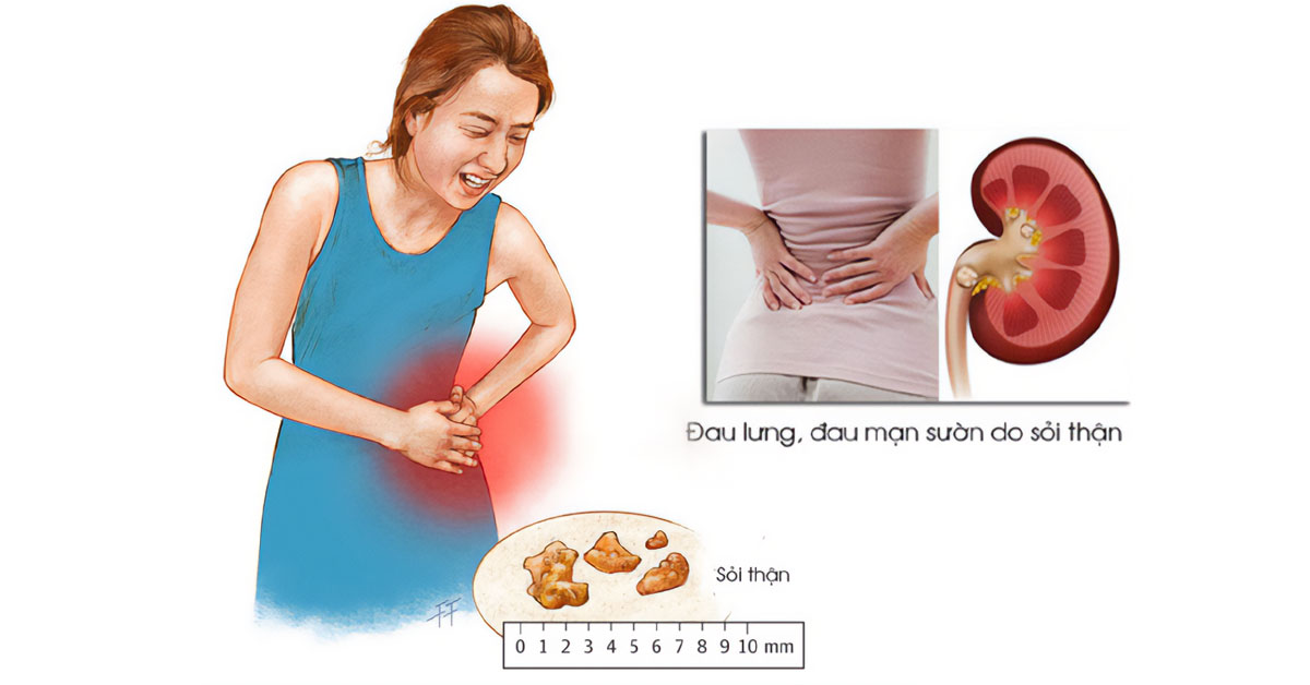 Sỏi thận là một trong những biến chứng thường gặp của thận đa nang Sỏi thận là một trong những biến chứng thường gặp của thận đa nang