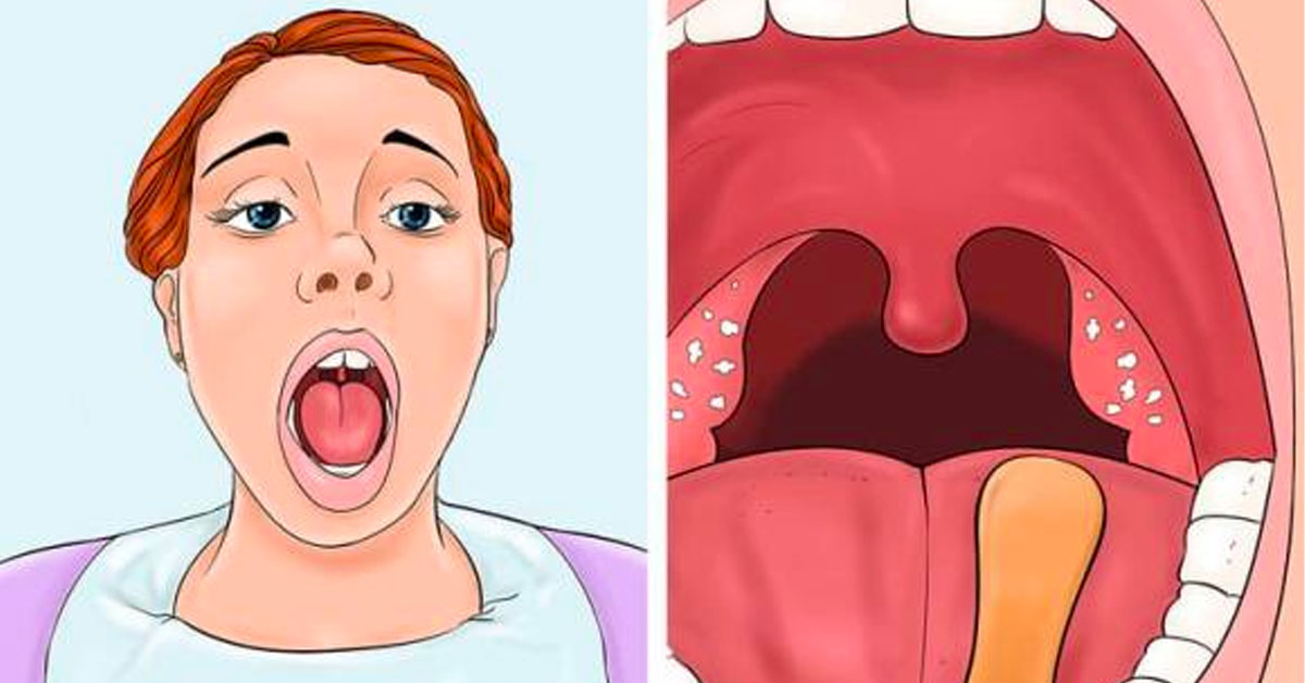 Sỏi amidan là gì?