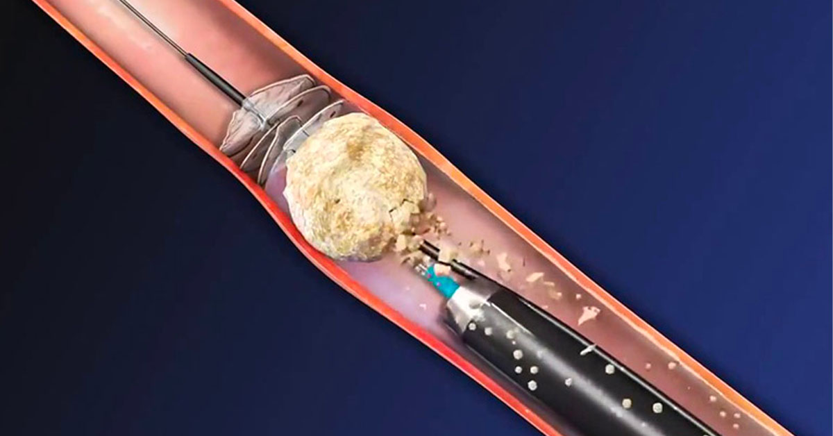 Tán sỏi mật bằng laser là phương pháp hiện đại, ít xâm lấn 