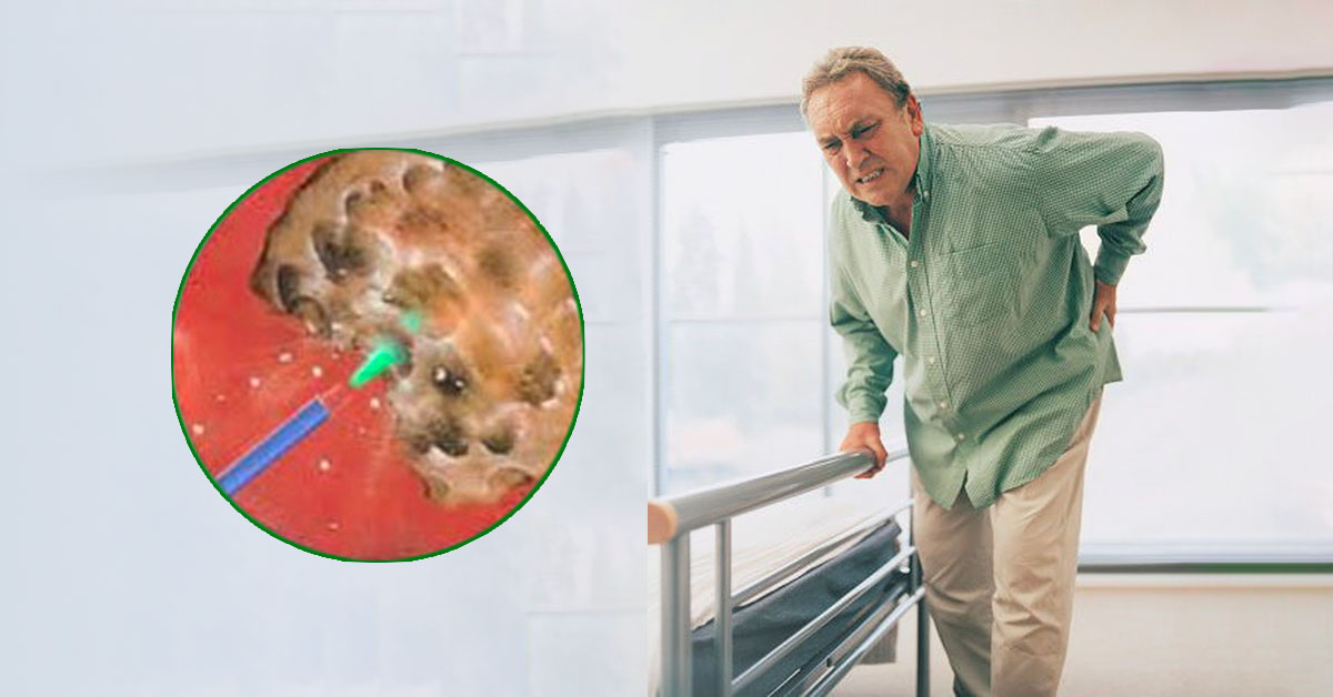 Tan sỏi mật bằng laser có thể áp dụng với người lớn tuổi và mắc bệnh nền 