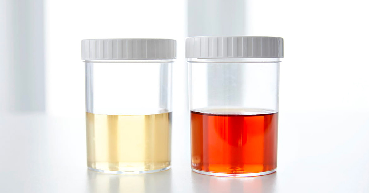 Xuất huyết khi tiểu được gọi là tiểu ra máu Xuất huyết khi tiểu được gọi là tiểu ra máu