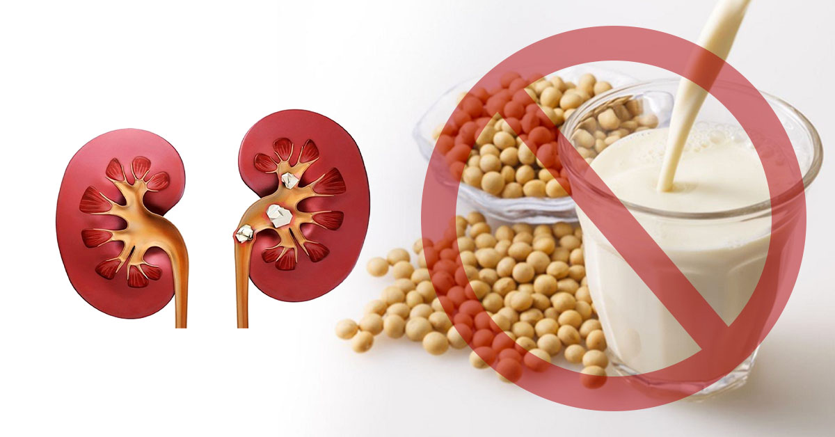 Người mắc sỏi thận không nên dùng sữa đậu nành Người mắc sỏi thận không nên dùng sữa đậu nành