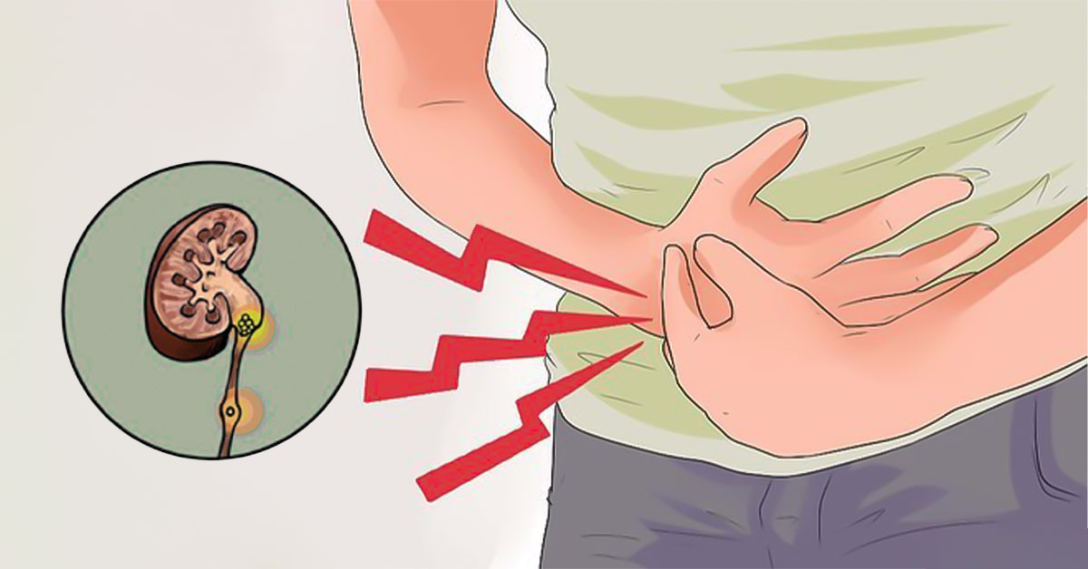  Sỏi thận là một trong những nguyên do dẫn đến tiểu buốt