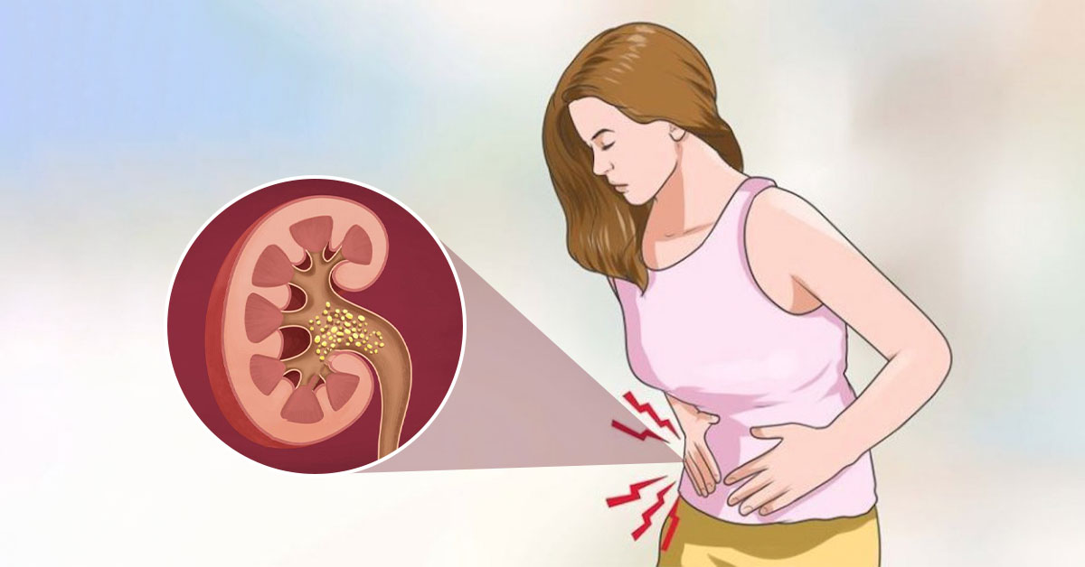 Cặn sỏi thận là những mảnh sạn nhỏ rất dễ hình thành nên sỏi thận 