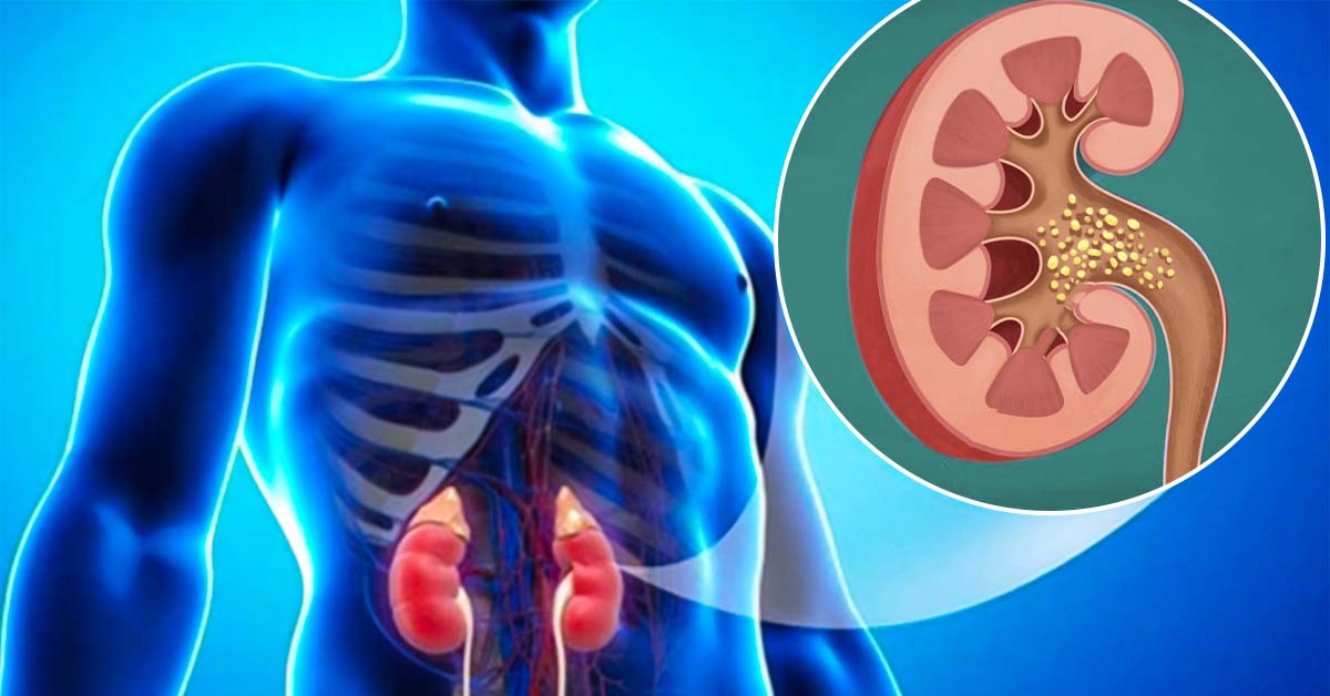  Cặn sỏi ảnh hưởng đến chức năng của thận 