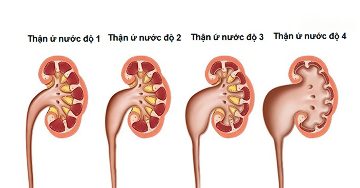 Thận ứ nước là một trong những biến chứng nguy hiểm của sỏi thận 