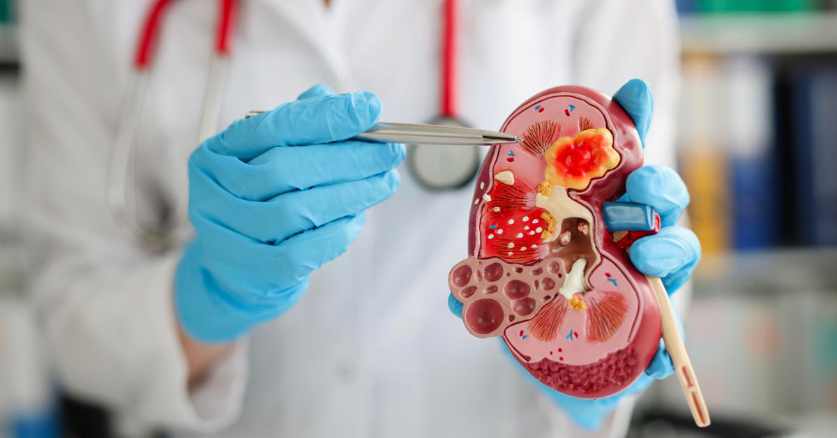 Tiêu chí lựa chọn phương pháp điều trị sỏi thận 