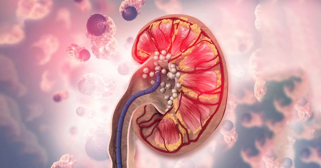 Sỏi thận hình thành do quá trình tích tụ các chất rắn lâu ngày không được đào thải ra ngoài 