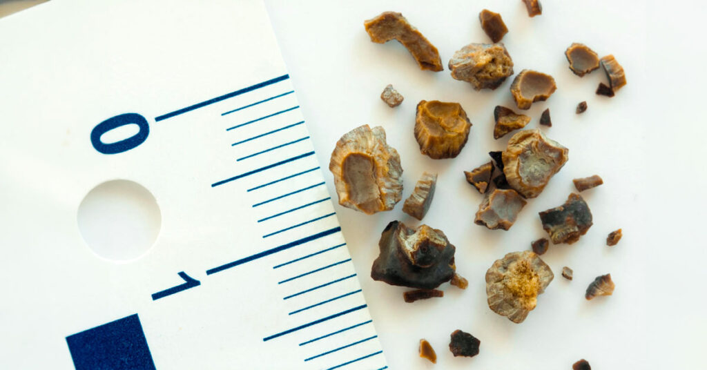  Sỏi thận 7mm là to hay nhỏ?