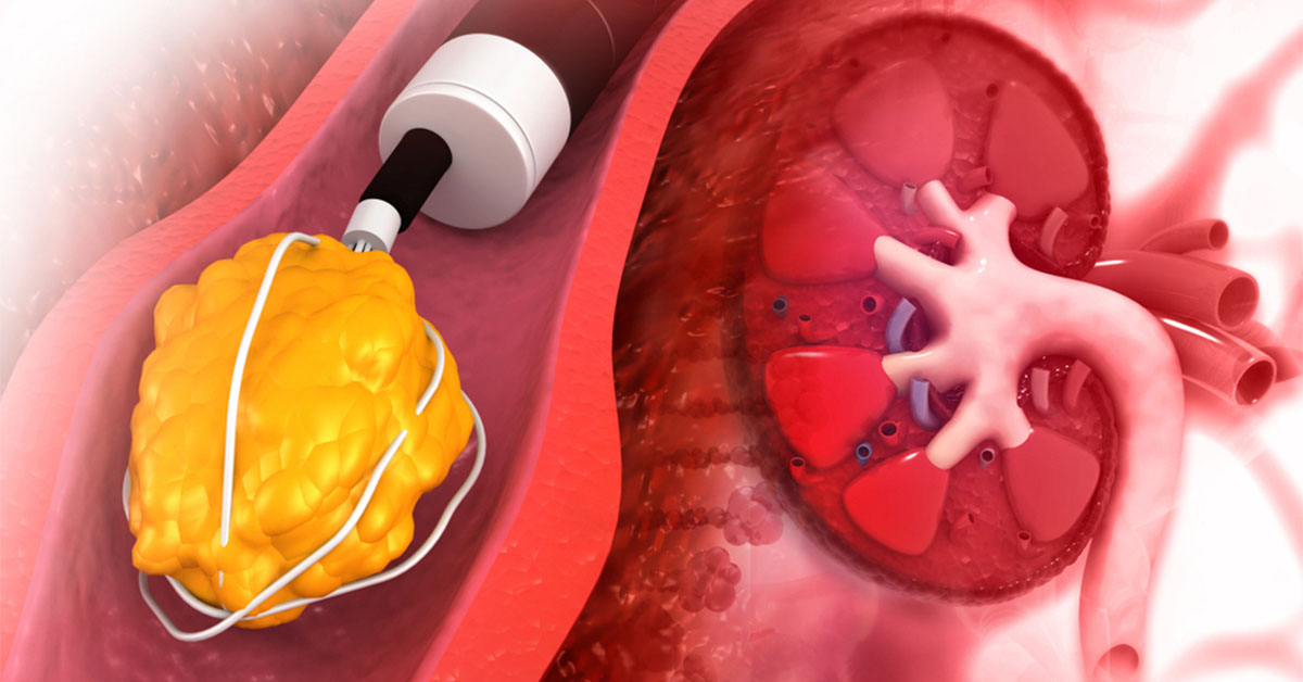 Khi nào nên tán sỏi thận?