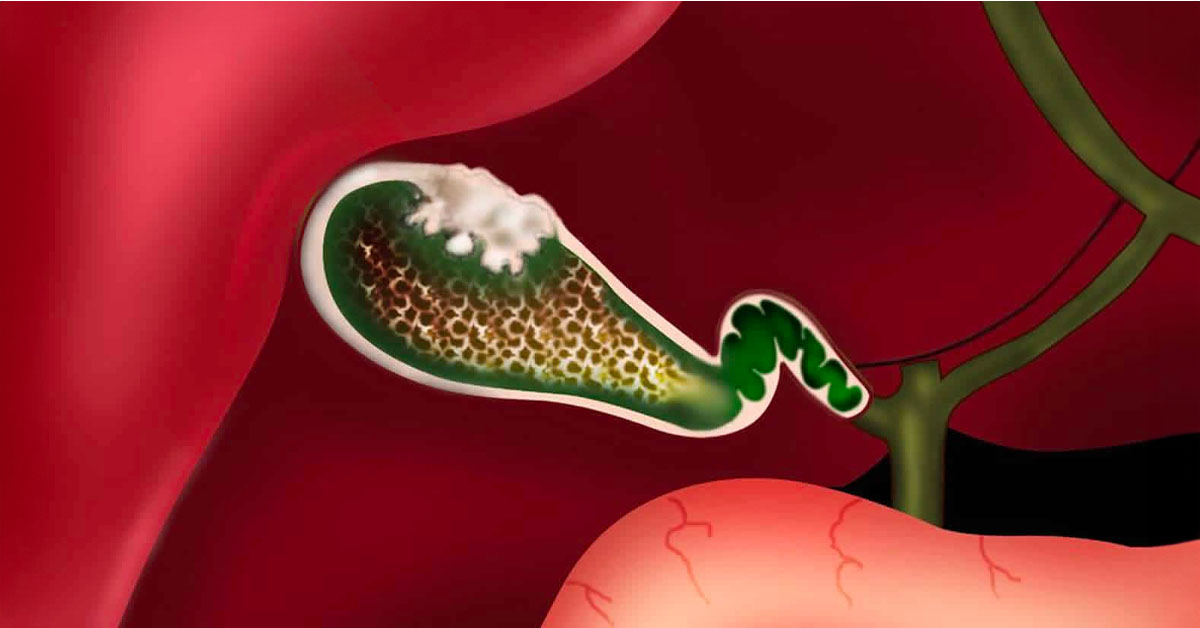  Polyp túi mật là gì?