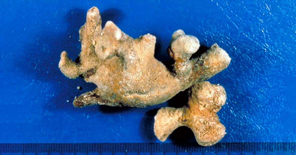 Sỏi san hô là gì?