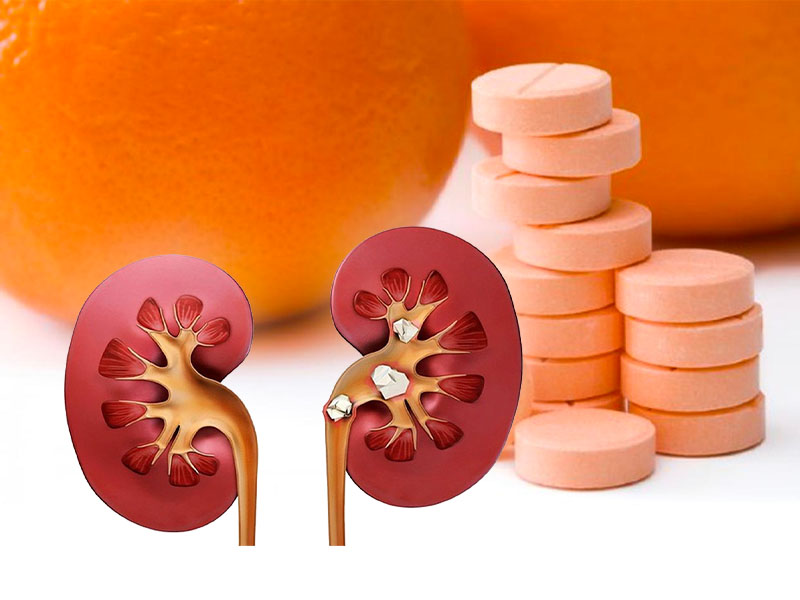  Bổ sung vitamin C liều cao trong thời gian dài sẽ gây nên sỏi thận 