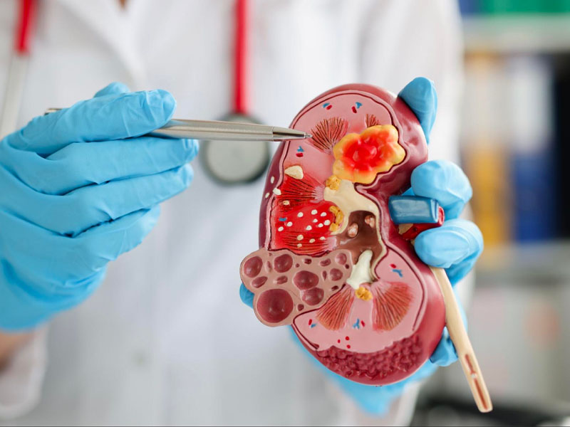 Cặn thận là gì?