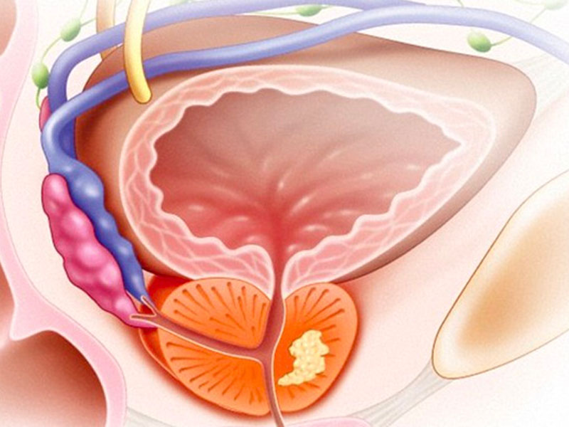 Sỏi tuyến tiền liệt là gì?