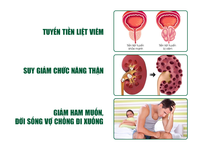3 Biến chứng nguy hiểm của sỏi tiền liệt ở nam