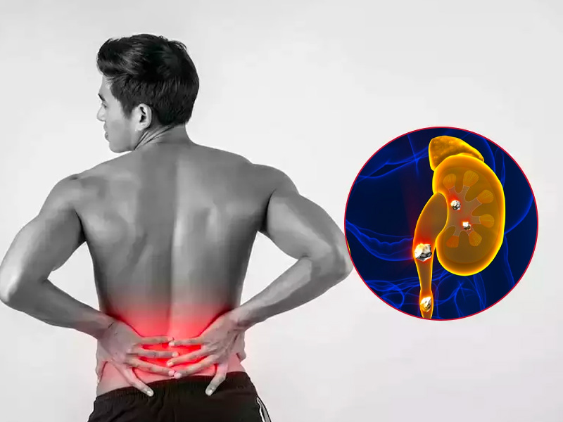 Sỏi niệu quản 8mm cực kì nguy hiểm