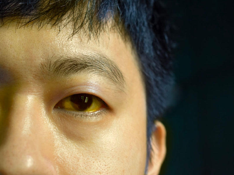 Vàng da là biểu hiện thường gặp của bệnh gan