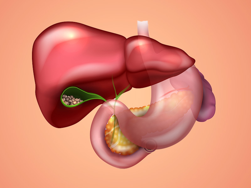 Sỏi mật gây xơ gan