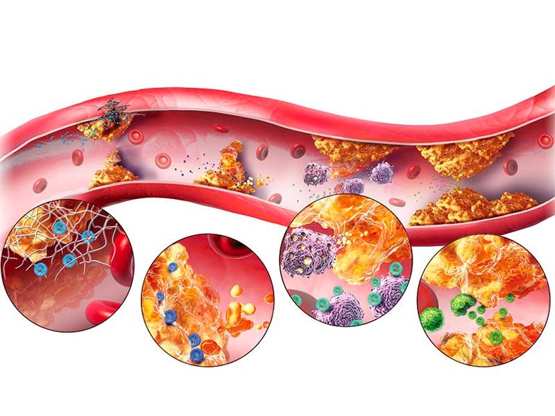 Rối loạn cholesterol là nguyên nhân bị sỏi mật