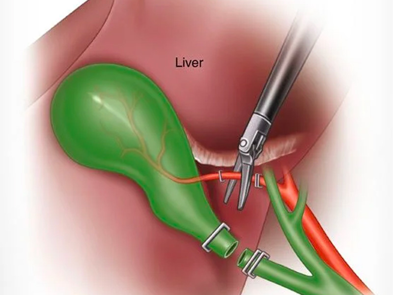 3 Trường hợp bị cắt túi mật