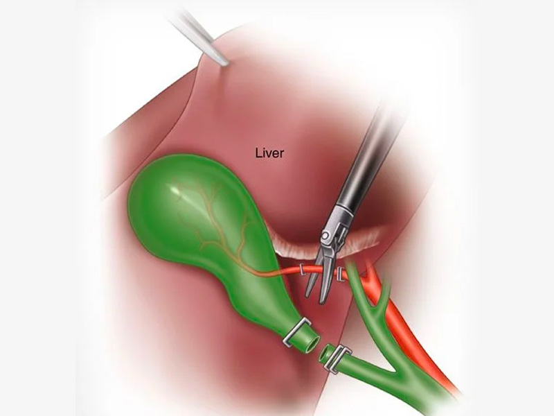 Lúc nào nên cắt túi mật?