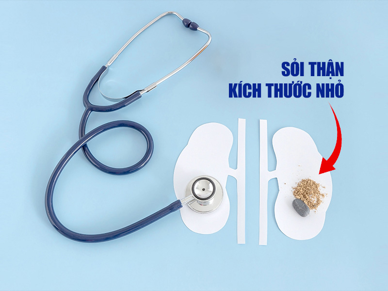 Sỏi thận có kích thước nhỏ thời gian tự đào thải nhanh
