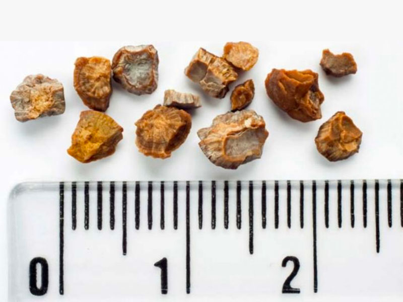 Kích thước sỏi thận bao nhiêu là nguy hiểm?