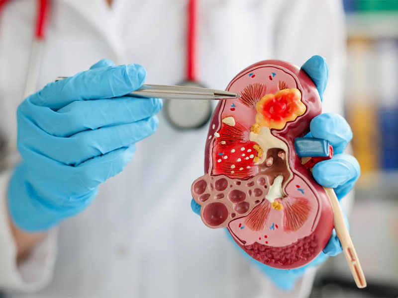 Sỏi thận làm suy thận nếu không được chữa trị kịp thời 