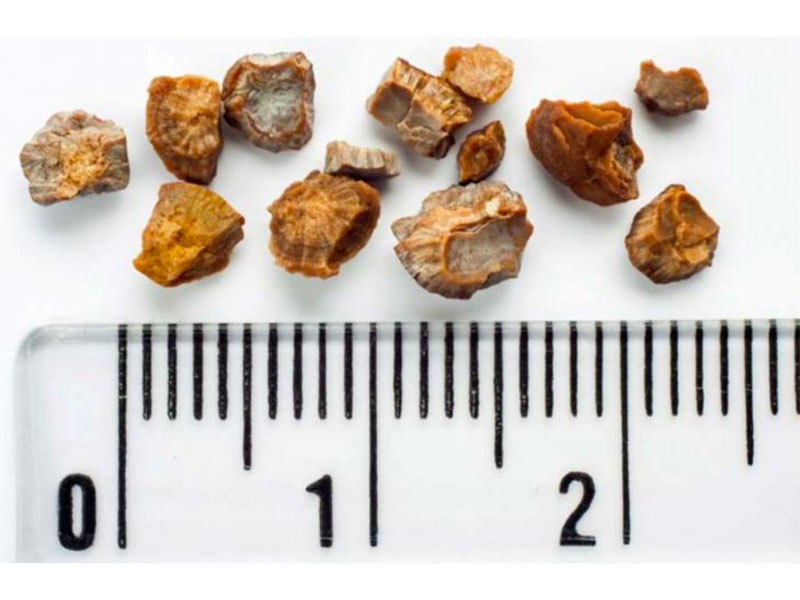 Sỏi thận kích thước bao nhiêu phải mổ?