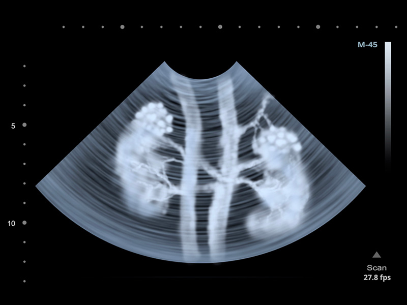  Kết quả siêu âm sỏi thận giúp cho việc phẫu thuật được chuẩn xác hơn