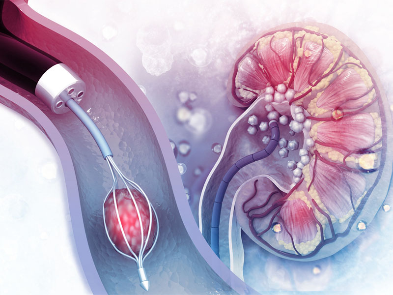 Mổ nội soi sỏi thận nên ăn gì?