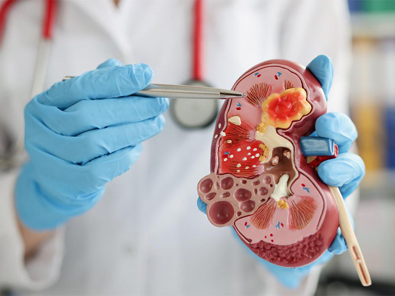 Chỉ định mổ nội soi sỏi thận khi nào?
