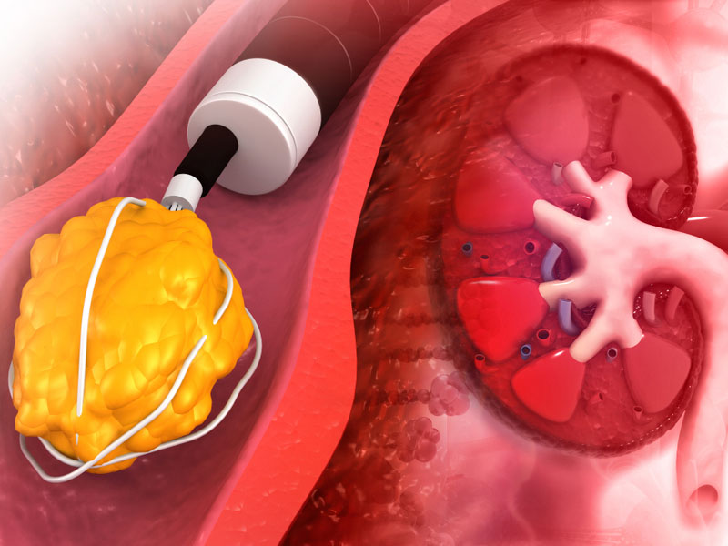 Chi phí phẫu thuật nội soi lấy sỏi thận là bao nhiêu?