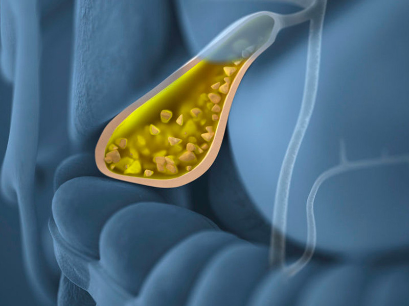 Bùn túi mật có nguy hiểm không?