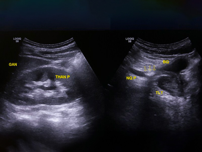  Hình ảnh siêu âm sỏi thận 