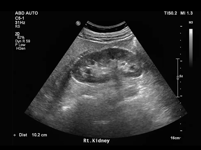 Siêu âm có phát hiện sỏi thận không?