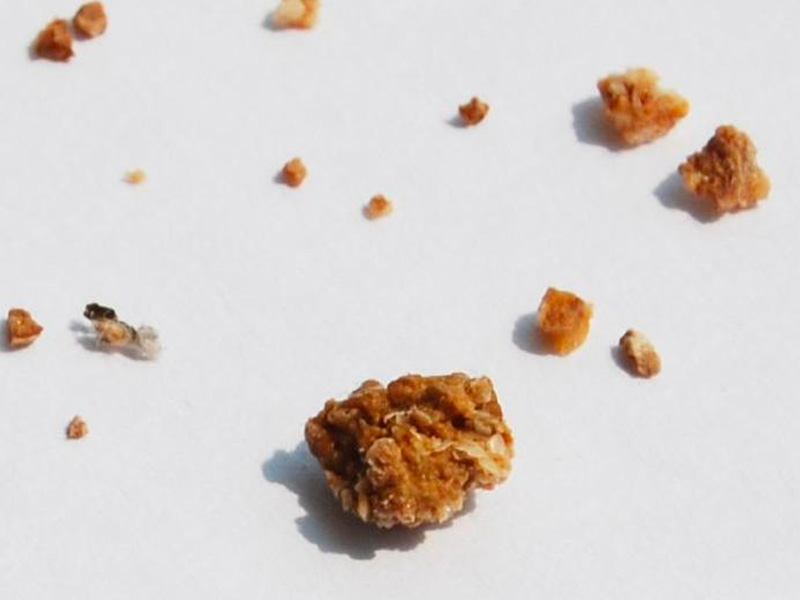 Sỏi canxi là gì?