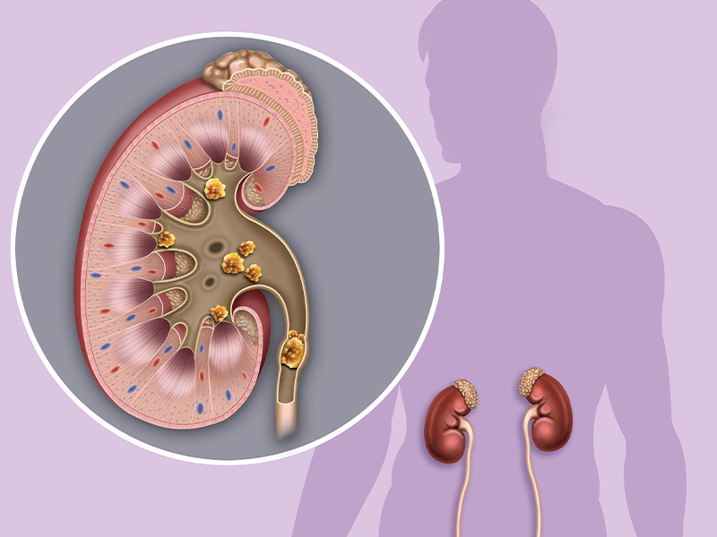  Sỏi thận tái lại phải làm sao?