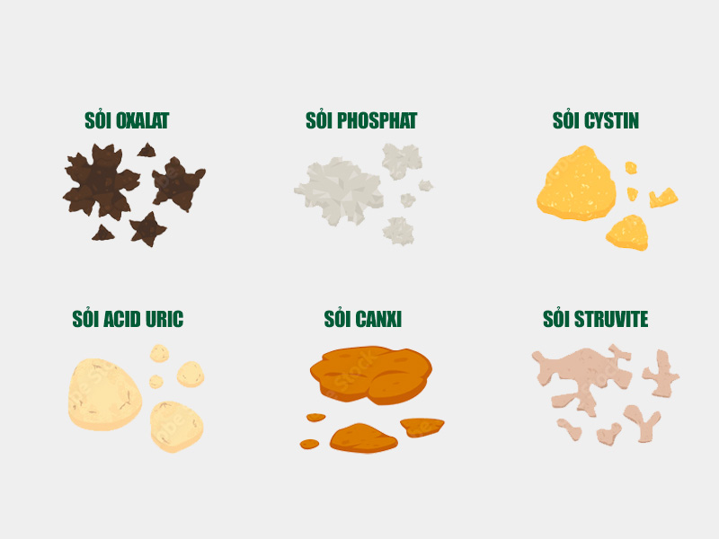 Sỏi thận dạng canxi và oxalat chiếm tỷ lệ cao nước ta