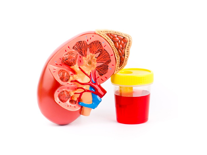 Tiểu ra máu là dấu hiệu của bệnh sỏi tiết niệu