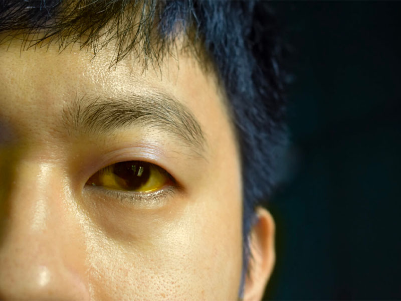 Vàng mắt và vàng da là triệu chứng của bệnh viêm túi mật