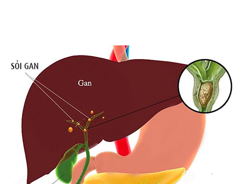 Bệnh sỏi gan là gì?