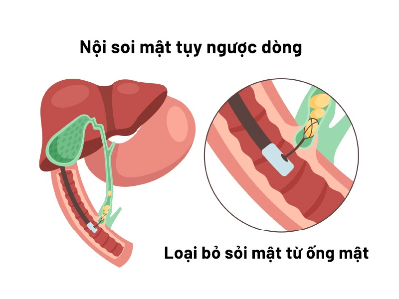 Có nên mổ lấy sỏi đường ống mật chủ không?