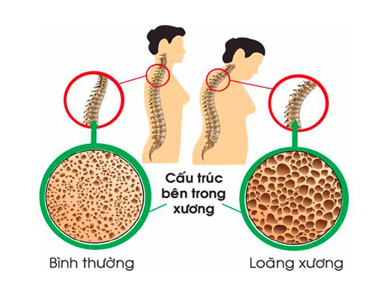  Thiếu canxi cơ thể sẽ như thế nào?