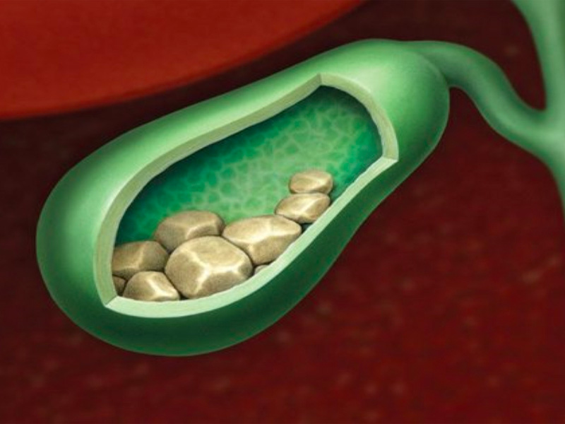 Sỏi có kích thước càng lớn sẽ càng nguy hại đến chức năng của gan, mật