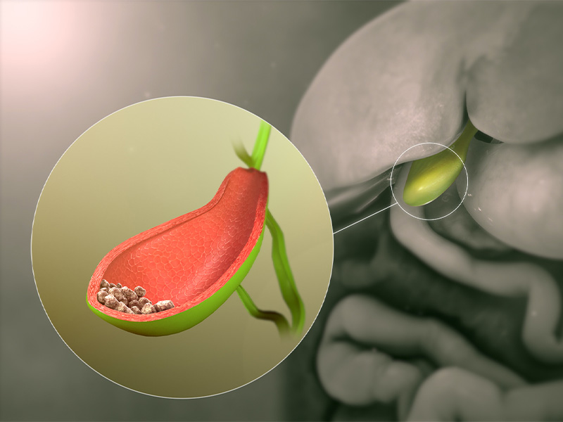 Bị sỏi túi mật 11mm có nguy hiểm không?